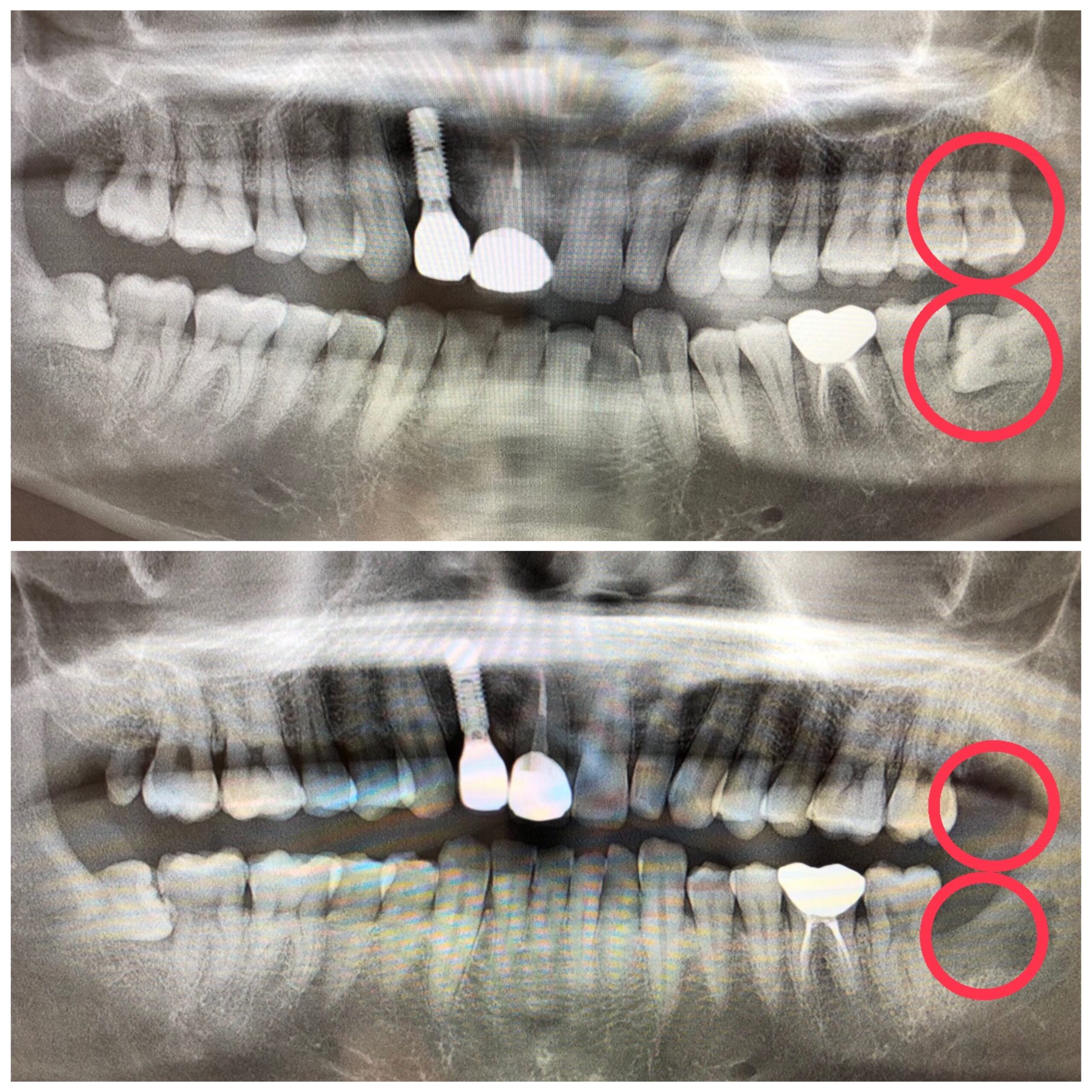 抜歯の難易度について 八潮の歯医者なら子どもが楽しい歯医者さんlealea歯科 矯正歯科クリニック