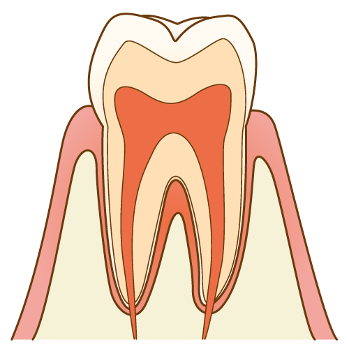 虫歯の進行段階と各治療方法について 八潮の歯医者なら子どもが楽しい歯医者さんlealea歯科 矯正歯科クリニック