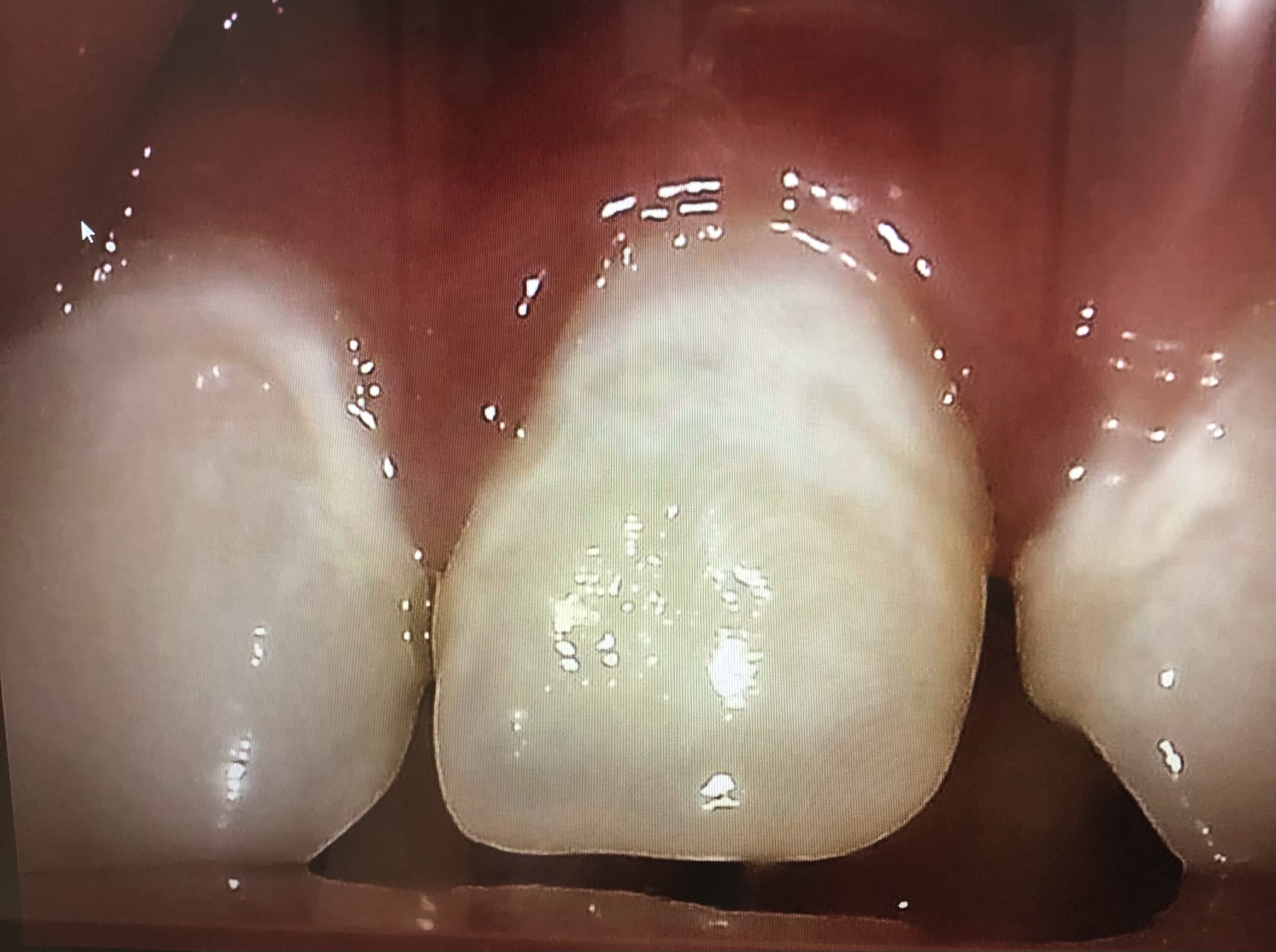 見逃さないで子供の歯の白濁 八潮の歯医者 Lealea歯科 矯正歯科クリニック