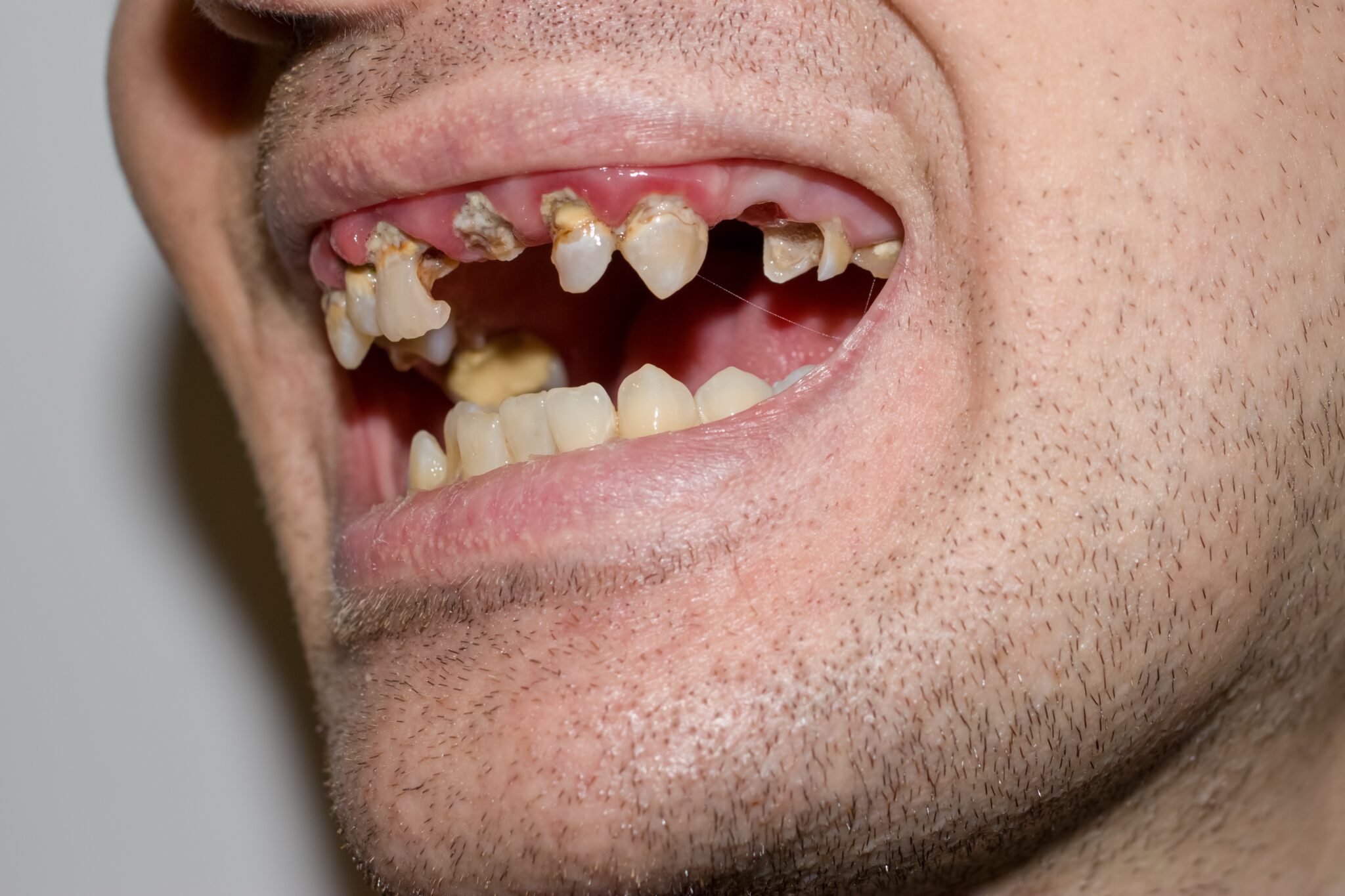 ブレースを使用した歯のクリーニング