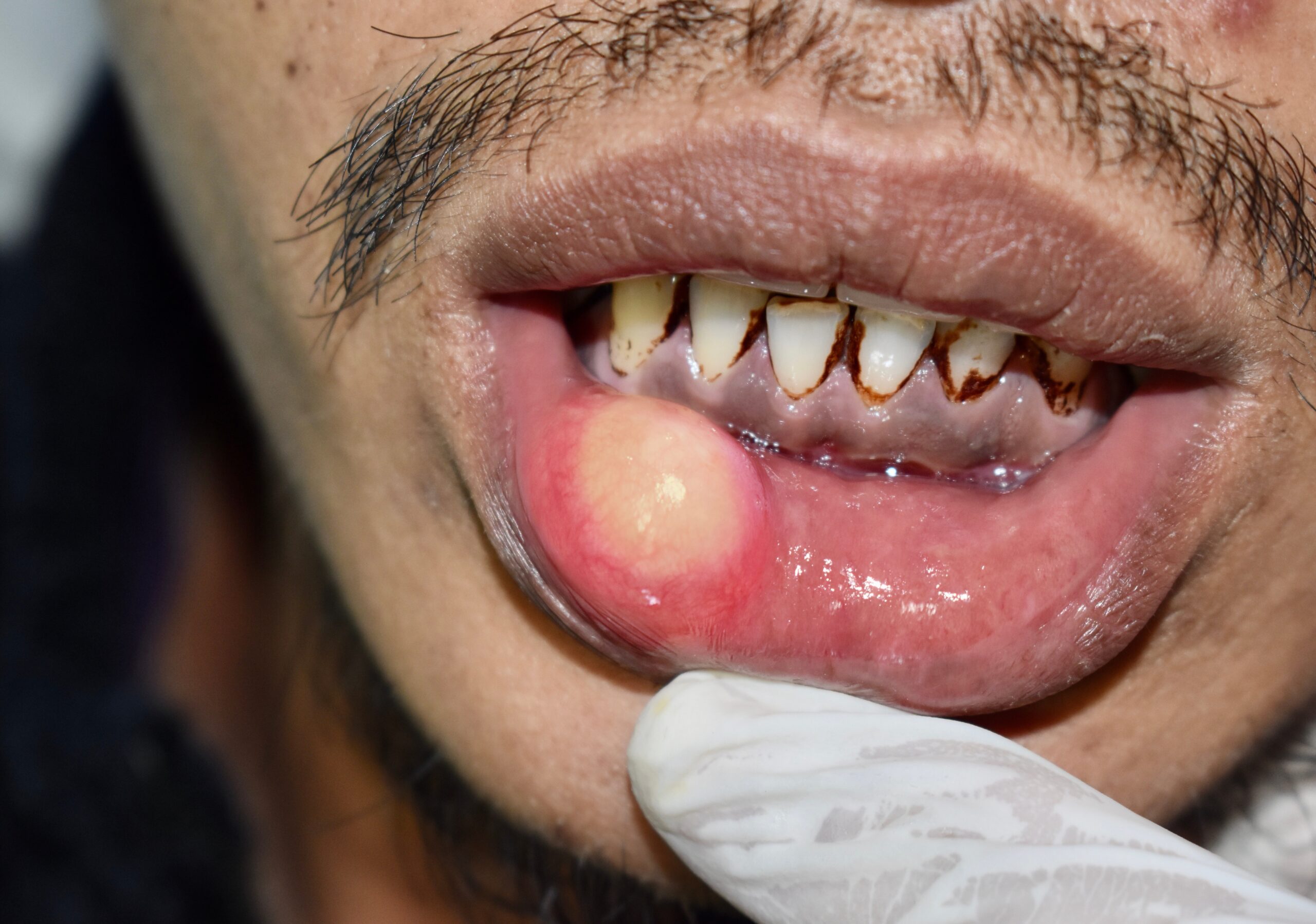 唇に水膨れ これって粘液嚢胞 八潮の歯医者なら子どもが楽しい歯医者さんlealea歯科矯正歯科クリニック