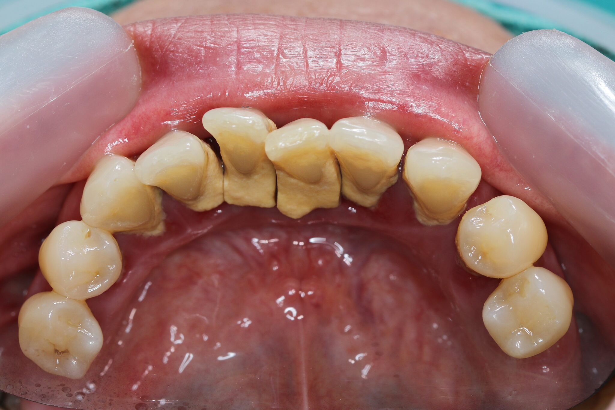 歯 の 歯石