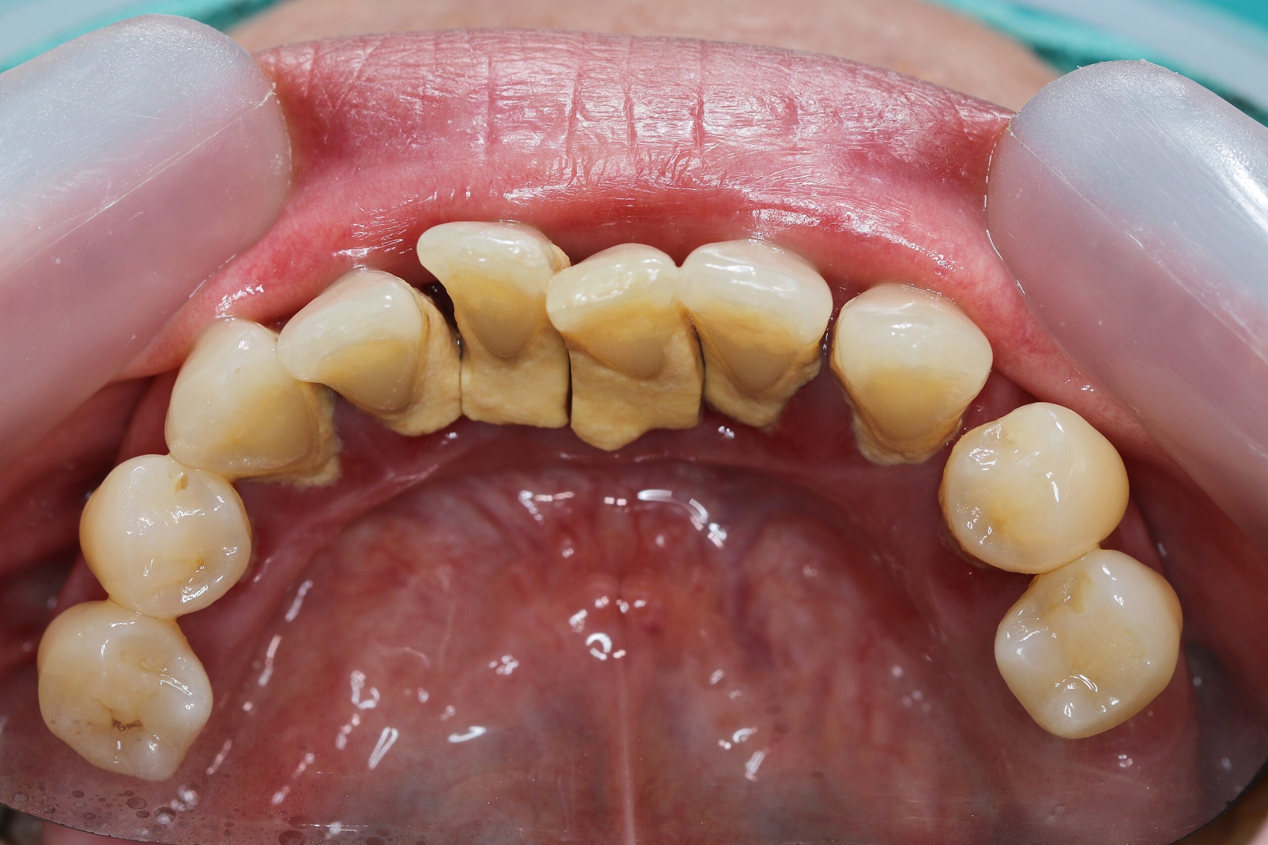 下 の 前歯 歯石