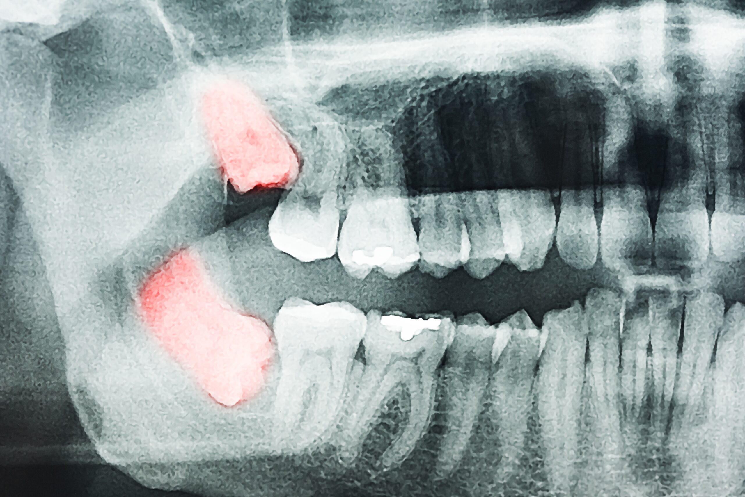 親知らずの生え方による様々なデメリット 八潮の歯医者なら子どもが楽しい歯医者さんlealea歯科 矯正歯科クリニック